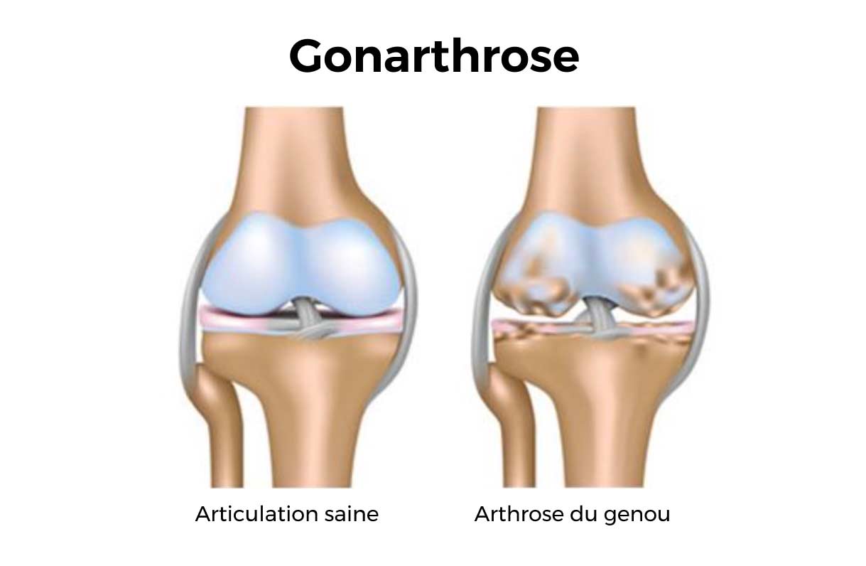 Genou sain vs genou arthrosique