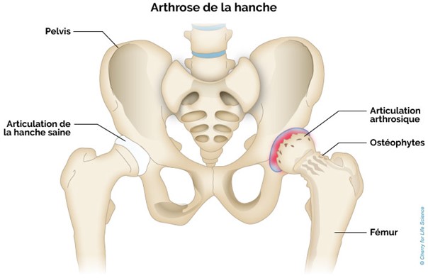 Arthrose de la hanche
