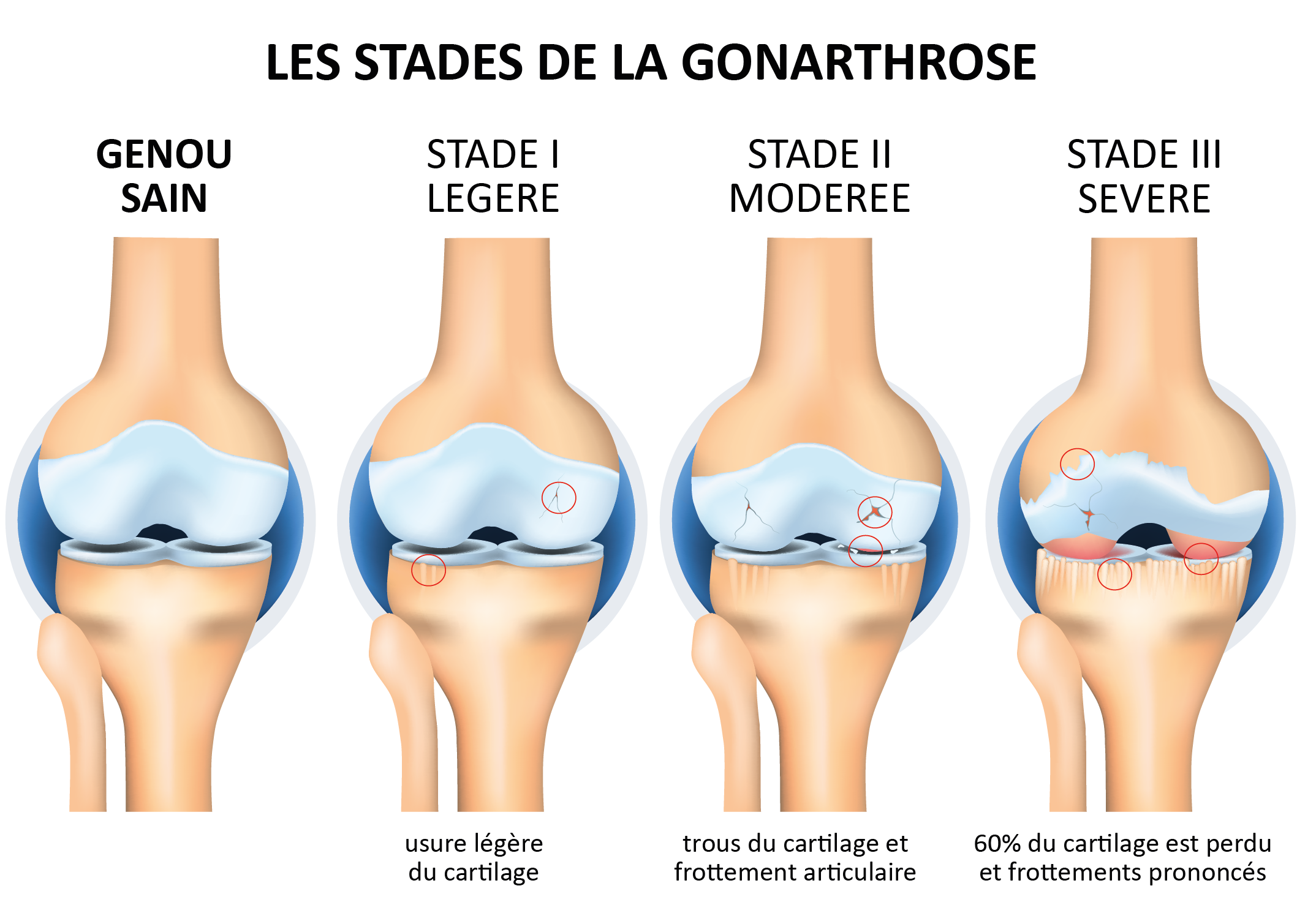 Arthrose du genou