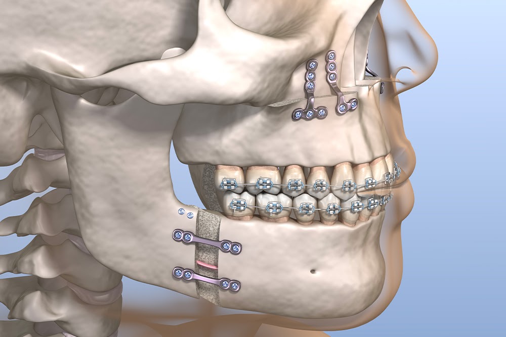 Chirurgie Maxillo-faciale